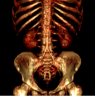kidney1