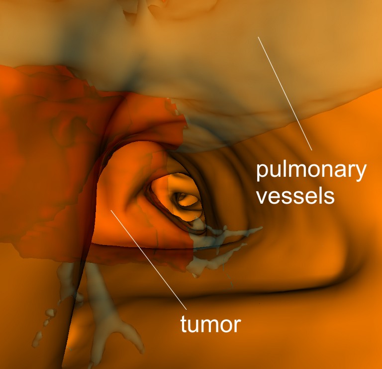 lung tumor
